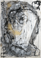 hydrocephalus_III